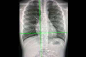 AI-powered X-rays can tell true age by looking at chest